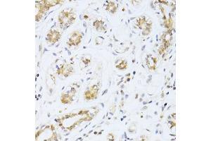 Immunohistochemistry of paraffin-embedded human breast cancer using ETV1 antibody (ABIN6129794, ABIN6140327, ABIN6140329 and ABIN6217250) at dilution of 1:100 (40x lens).
