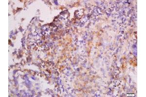 Formalin-fixed and paraffin embedded human lung carcinoma labeled with Anti-CK7 Polyclonal Antibody, Unconjugated  at 1:300 followed by conjugation to the secondary antibody and DAB staining. (Cytokeratin 7 anticorps  (AA 251-350))