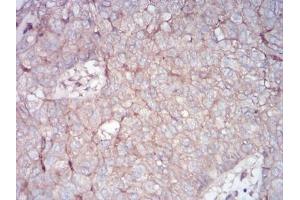 Immunohistochemical analysis of paraffin-embedded bladder cancer tissues using RALA mouse mAb with DAB staining.