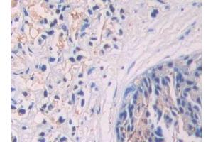 Detection of SIGIRR in Human Prostate cancer Tissue using Polyclonal Antibody to Single Ig IL1 Related Receptor (SIGIRR)