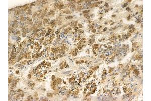 ABIN6256349 and ABIN6267599 at 1/100 staining human melanoma by IHC-P.