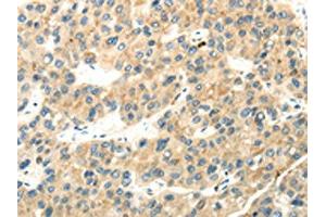 The image on the left is immunohistochemistry of paraffin-embedded Human liver cancer tissue using ABIN7193040(WDR36 Antibody) at dilution 1/35, on the right is treated with synthetic peptide. (WDR36 anticorps)