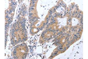 The image on the left is immunohistochemistry of paraffin-embedded Human colon cancer tissue using ABIN7131299(TAT Antibody) at dilution 1/35, on the right is treated with fusion protein. (Tat anticorps)