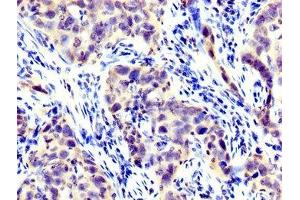 IHC image of ABIN7158430 diluted at 1:300 and staining in paraffin-embedded human pancreatic cancer performed on a Leica BondTM system.