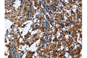The image on the left is immunohistochemistry of paraffin-embedded Human thyroid cancer tissue using ABIN7130029(KLRB1 Antibody) at dilution 1/40, on the right is treated with fusion protein.