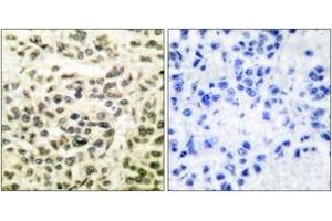 Immunohistochemistry analysis of paraffin-embedded human breast carcinoma tissue, using GSK3 alpha/beta (Ab-279/216) Antibody. (GSK3 alpha/beta anticorps  (AA 246-295))