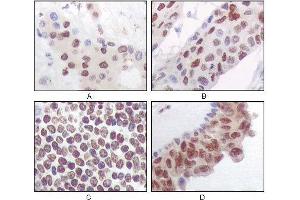 Immunohistochemical analysis of paraffin-embedded human liver carcinoma (A), esophagus carcinoma (B), normal spleen tissue(C), breast carcinoma (D), showing nuclear and cytoplasmic localization using PRAK mouse mAb with DAB staining.