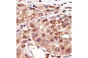 Formalin-fixed and paraffin-embedded human cancer tissue reacted with the primary antibody, which was peroxidase-conjugated to the secondary antibody, followed by AEC staining. (MTM1 anticorps  (N-Term))