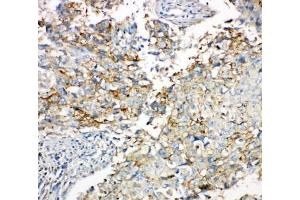 IHC-P: Cx43 antibody testing of human lung cancer tissue