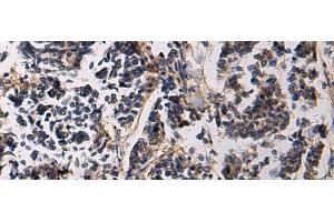 Immunohistochemistry of paraffin-embedded Human breast cancer tissue using SSH3 Polyclonal Antibody at dilution of 1:60(x200) (SSH3 anticorps)