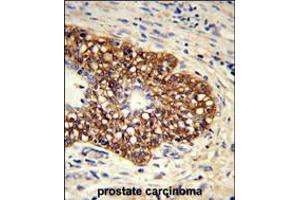 Formalin-fixed and paraffin-embedded human prostate carcinoma reacted with CYP8A1 Antibody , which was peroxidase-conjugated to the secondary antibody, followed by DAB staining. (PTGIS anticorps  (C-Term))