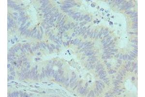 Immunohistochemistry of paraffin-embedded human colon cancer using ABIN7147246 at dilution of 1:100