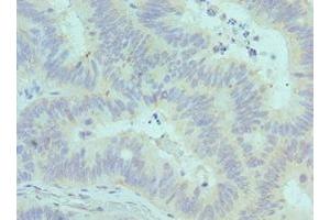 Immunohistochemistry of paraffin-embedded human colon cancer using ABIN7147246 at dilution of 1:100 (CADM1 anticorps  (AA 45-344))