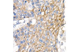 Immunohistochemistry of paraffin-embedded Human lung squamous carcinoma tissue using δ-Catenin/p120 Catenin antibody (ABIN7266144) at dilution of 1:500 (40x lens). (CTNND1 anticorps)