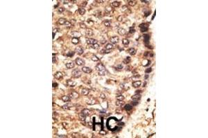 Formalin-fixed and paraffin-embedded human cancer tissue reacted with the primary antibody, which was peroxidase-conjugated to the secondary antibody, followed by AEC staining.