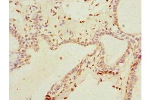 Immunohistochemistry of paraffin-embedded human breast cancer using ABIN7172156 at dilution of 1:100 (THRSP anticorps  (AA 1-146))