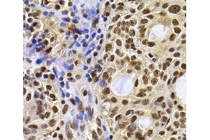 Immunohistochemistry of paraffin-embedded Human oophoroma using HIRIP3 Polyclonal Antibody at dilution of 1:100 (40x lens).