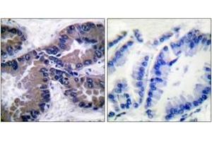 Immunohistochemistry analysis of paraffin-embedded human lung carcinoma tissue, using Nrf2 Antibody. (NRF2 anticorps  (AA 556-605))