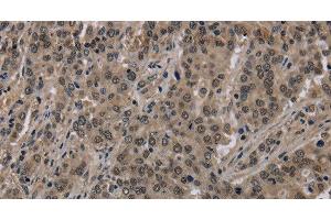 Immunohistochemistry of paraffin-embedded Human liver cancer using HIST1H2AH Polyclonal Antibody at dilution of 1:40 (HIST1H2AH anticorps)