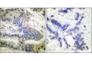 Immunohistochemistry analysis of paraffin-embedded human colon carcinoma, using Caspase 6 (Phospho-Ser257) Antibody. (Caspase 6 anticorps  (pSer257))