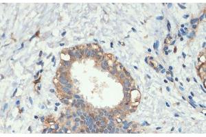 Immunohistochemistry of paraffin-embedded Human breast cancer using Smad5 Polyclonal Antibody at dilution of 1:200 (40x lens).