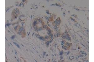 Detection of F1+2 in Human Pancreatic cancer Tissue using Polyclonal Antibody to Prothrombin Fragment 1+2 (F1+2)