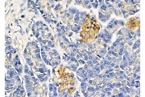 ABIN6265463 and ABIN6278640 at 1/100 staining Human pancreatic cancer and adjacent non-tumor tissue by IHC-P.