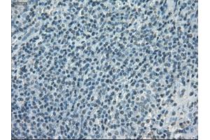 Immunohistochemical staining of paraffin-embedded lymphoma tissue using anti-PORmouse monoclonal antibody. (POR anticorps)