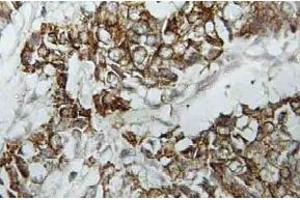 Immunohistochemistry (IHC) analyzes of HLA-DOalpha antibody in paraffin-embedded human breast carcinoma tissue. (HLA-DOA anticorps)