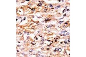 Formalin-fixed and paraffin-embedded human cancer tissue reacted with the primary antibody, which was peroxidase-conjugated to the secondary antibody, followed by AEC staining.