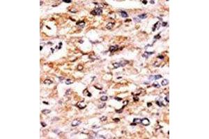 Formalin-fixed and paraffin-embedded human cancer tissue reacted with the primary antibody, which was peroxidase-conjugated to the secondary antibody, followed by AEC staining. (GCN2 anticorps  (C-Term))