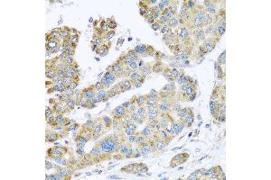 Immunohistochemistry of paraffin-embedded human liver cancer using SYT4 antibody at dilution of 1:100 (x40 lens). (SYT4 anticorps)