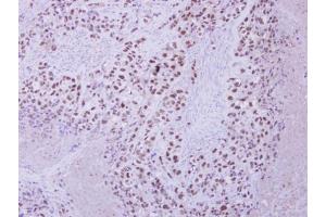 IHC-P Image Immunohistochemical analysis of paraffin-embedded H661 xenograft, using ZNF217 antibody [N3C2], Internal, antibody at 1:250 dilution. (ZNF217 anticorps)