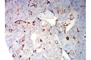 Immunohistochemical analysis of paraffin-embedded breast cancer tissues using NCAM1 mouse mAb with DAB staining. (CD56 anticorps)