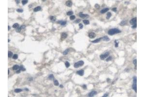 Detection of ARSA in Human Glioma Tissue using Polyclonal Antibody to Arylsulfatase A (ARSA) (Arylsulfatase A anticorps)