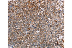 Immunohistochemistry of Human liver cancer using PLXNA2 Polyclonal Antibody at dilution of 1:40 (Plexin A2 anticorps)