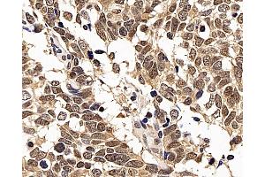 Immunohistochemistry analysis of paraffin-embedded human lung cancer using p27 Polyclonal Antibody at dilution of 1:200. (CDKN1B anticorps)