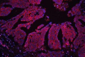 IF analysis of MPS1 using anti-MPS1 antibody (ABIN4886714) MPS1 was detected in paraffin-embedded section of human ovarian cancer tissues.