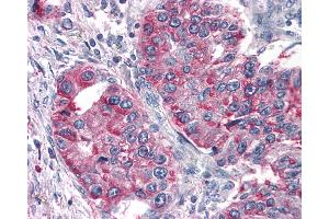 Anti-T1R3 / TAS1R3 antibody IHC of human Lung, Non-Small Cell Carcinoma. (TAS1R3 anticorps  (N-Term))