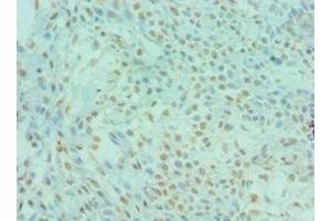 Immunohistochemistry of paraffin-embedded human breast cancer using ABIN7150791 at dilution of 1:100