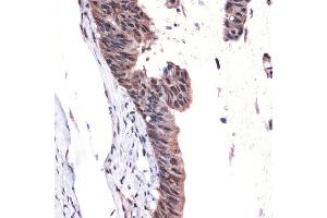 Immunohistochemistry of paraffin-embedded human colon carcinoma using MBD3 Rabbit mAb (ABIN7268492) at dilution of 1:100 (40x lens).
