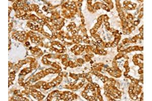 The image on the left is immunohistochemistry of paraffin-embedded Human thyroid cancer tissue using ABIN7130771(PTPN22 Antibody) at dilution 1/20, on the right is treated with fusion protein.