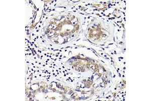 Immunohistochemistry of paraffin-embedded human breast cancer using IMPDH2 Rabbit pAb (ABIN7267853) at dilution of 1:100 (40x lens). (IMPDH2 anticorps  (AA 215-514))