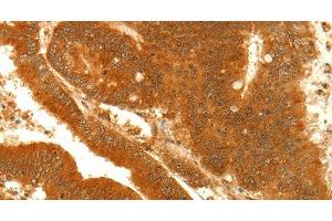 Immunohistochemistry of paraffin-embedded Human colon cancer using NAPA Polyclonal Antibody at dilution of 1:35