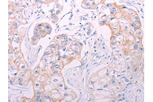 The image on the left is immunohistochemistry of paraffin-embedded Human breast cancer tissue using ABIN7189652(ADAMTS14 Antibody) at dilution 1/50, on the right is treated with synthetic peptide.