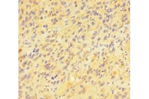 Immunohistochemistry of paraffin-embedded human glioma using ABIN7163391 at dilution of 1:100 (PAG1 anticorps  (AA 97-432))