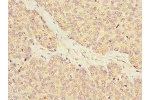 Immunohistochemistry of paraffin-embedded human ovarian cancer using ABIN7167152 at dilution of 1:100 (RASA4 anticorps  (AA 60-290))