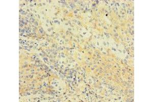 Immunohistochemistry of paraffin-embedded human cervical cancer using ABIN7174776 at dilution of 1:100 (C1orf112 anticorps  (AA 301-530))