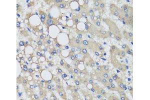 Immunohistochemistry of paraffin-embedded Human liver damage using PRODH Polyclonal Antibody at dilution of 1:100 (40x lens). (PRODH anticorps)