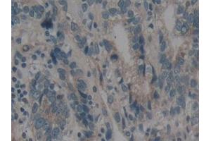 Detection of BMF in Human Stomach cancer Tissue using Polyclonal Antibody to Bcl2 Modifying Factor (BMF)